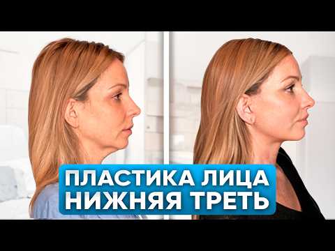 Видео: Подтяжка Нижней Трети Лица [от А до Я] - SMAS лифтинг