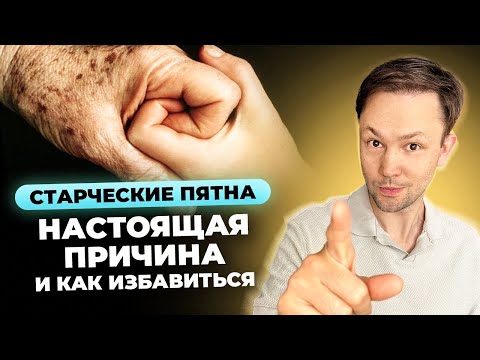 Видео: Пигментные пятна/Старческое лентиго. Как избавиться?