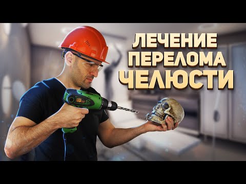 Видео: Все о лечение переломов нижней челюсти.
