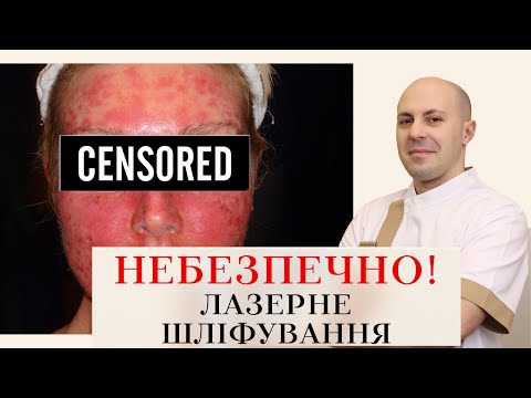 Видео: ЛАЗЕРНЕ ШЛІФУВАННЯ: ЯК СКОРОТИТИ РЕАБІЛІТАЦІЮ ⁉️👀  ЯК ОБРАТИ АПАРАТ❓🤔