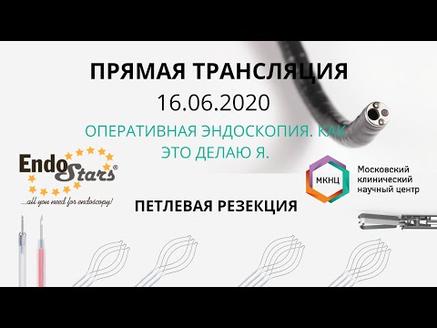 Видео: Петлевая резекция слизистой. Оперативная эндоскопия.