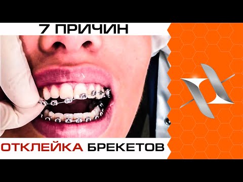 Видео: Почему  БРЕКЕТЫ ОТКЛЕИВАЮТСЯ? (7 причин)