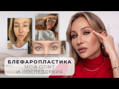 Видео: БЛЕФАРОПЛАСТИКА | ПОСМОТРИ ПРЕЖДЕ, ЧЕМ СДЕЛАТЬ!