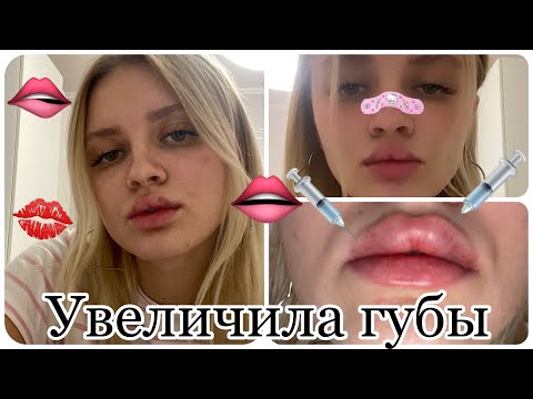 Видео: VLOG/ УВЕЛИЧИЛА ГУБЫ