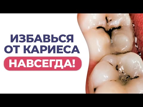 Видео: КАРИЕСА БОЛЬШЕ НЕ БУДЕТ! / Ошибки ухода за зубами и профилактика кариеса