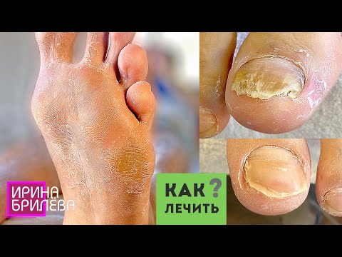 Видео: Грибок ногтей на ногах лечение 🌸 Как с этим бороться??? 🌸 Педикюр 🌸 Ирина Брилёва