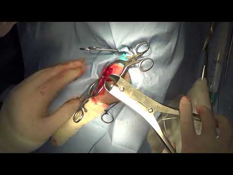 Видео: Транспозиция гребня большеберцовой кости
