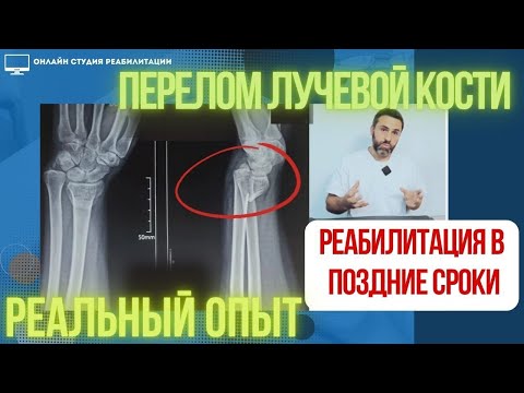 Видео: Перелом лучевой кости: реабилитация в поздние сроки, реальный опыт.