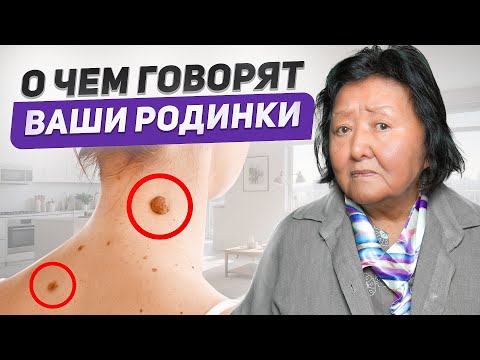 Видео: О чем говорят ваши родинки