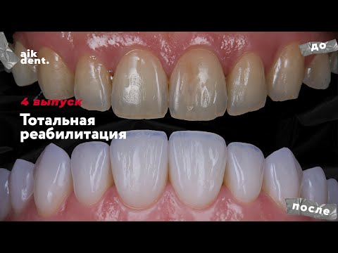 Видео: Виниры после ортодонтии. Выпуск 4. aikdent.school