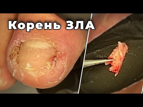 Видео: Ногтевой «зуб» Не давал потрогать место врастания. 