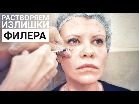 Видео: Растворяем излишки филера гиалуронидазой. Светлана #1