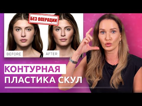 Видео: Скулы за 1 процедуру. Мгновенный эффект! Контурная пластика скул.