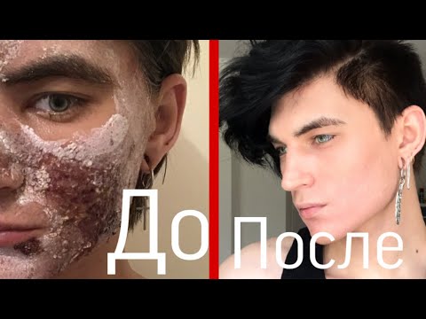 Видео: Результат Лазерной шлифовки лица от Рубцов| Моя история акне ,каким я лекарством победил прыщи