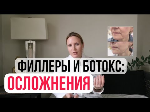 Видео: Последствия и опасность после филлеров и ботокс у косметолога #ботокс #филлеры #косметолог