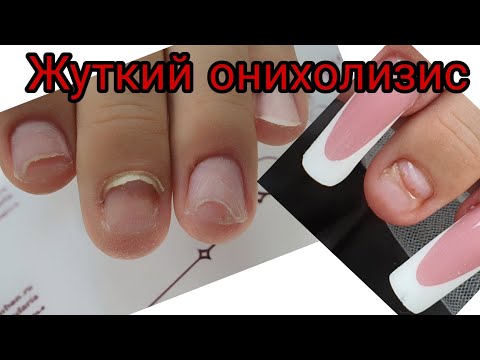 Видео: вырван ноготь с мясом.ужасный маникюр.онихолизис как с ним бороться.наращивание ногтей на онихолизис