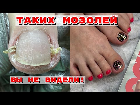 Видео: ОГРОМНЫЕ😱подногтевые мозоли‼️ПЛЁНКИ в педикюре