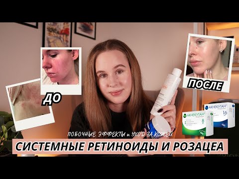 Видео: ЛЕЧЕНИЕ РОЗАЦЕА СИСТЕМНЫМИ РЕТИНОИДАМИ (АКНЕКУТАН) | МОЙ ОПЫТ