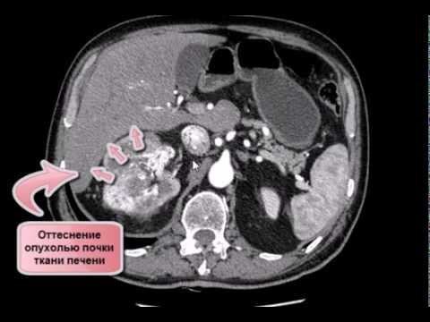 Видео: КТ брюшной полости (опухоль почки и тромбоз полой вены)