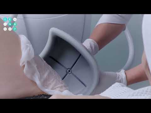 Видео: Криолиполиз на аппарате Clatuu - что это за процедура? | сеть клиник косметологии GEN87