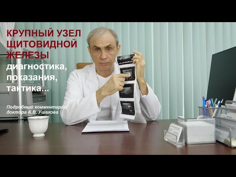 Видео: Крупный узел. УЗИ, Цитологическое исследование и Сцинтиграфия узла щитовидной железы.