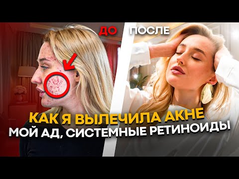 Видео: КАК ЛЕЧИТЬ АКНЕ? Моя история за 7 месяцев в ремиссию. Системные ретиноиды