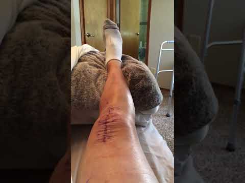 Видео: Полное эндопротезирование коленного сустава. День 3: Поймите, что происходит на самом деле