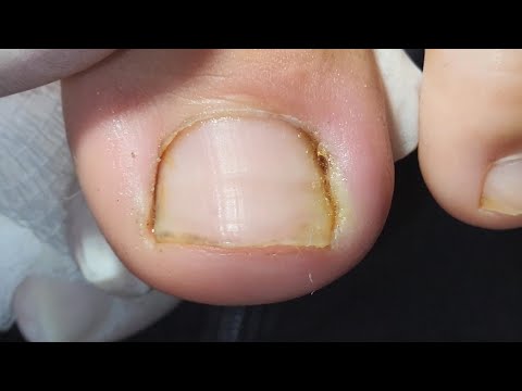 Видео: ОГРОМНЫЙ ВРОСШИЙ НОГОТЬ С ГНОЕМ (с субтитрами)