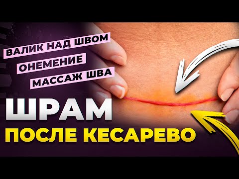 Видео: Шов после кесарева: убираем «валик», боль и онемение — 3 шага дома