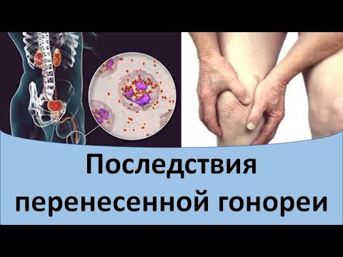 Видео: Последствия гонореи