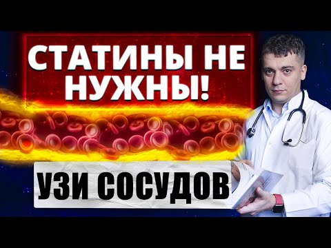 Видео: НУЖНЫ ЛИ СТАТИНЫ?! УЗНАЙ ПО УЗИ СОСУДОВ ШЕИ - БРАХИОЦЕФАЛЬНЫХ АРТЕРИЙ!
