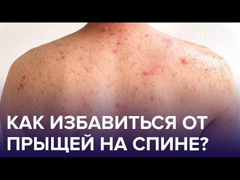 Видео: Из-за чего появляются ПРЫЩИ на спине? Как от них избавиться? | Доктор 24