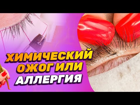 Видео: Химический ожог или аллергия при наращивании ресниц