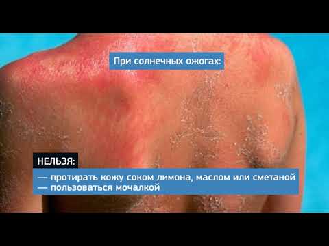 Видео: Врачи объяснили, как правильно лечить солнечные ожоги