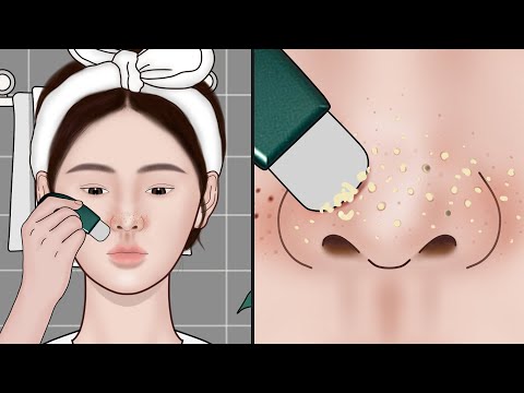 Видео: Как удалить угри в домашних условиях? Анимация ASMR для удаления угрей | Meng's Stop Motion
