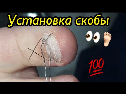 Видео: Установка скобы🦶🏻👀💯