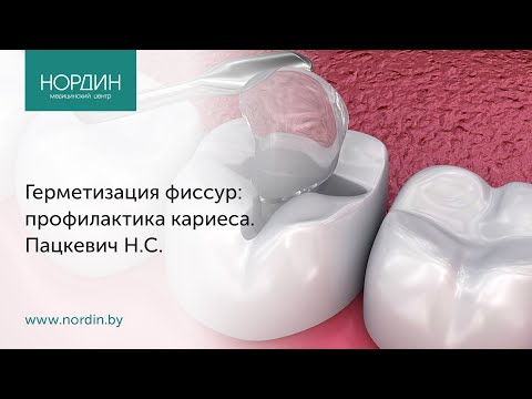 Видео: Герметизация фиссур