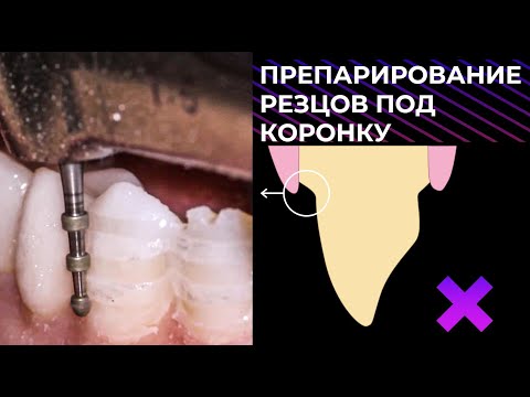 Видео: ПРЕПАРИРОВАНИЕ 6 ЗУБОВ ПОД КОРОНКУ