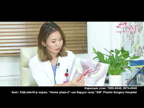 Видео: Үтрээний пластик мэс засал гэж юу вэ?