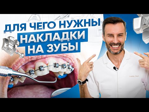 Видео: Накладки на зубы при установке брекетов. Для чего они нужны? Исправление прикуса