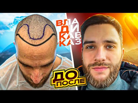 Видео: РЕЗУЛЬТАТ ПЕРЕСАДКИ ВОЛОС ВО ВЛАДИКАВКАЗЕ