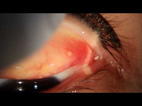Видео: Удаление камня из глаза