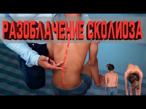 Видео: Что такое сколиоз?