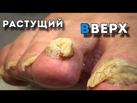Видео: Как грибок съел ноготь полностью. Ликвидация всего пораженного #podologia