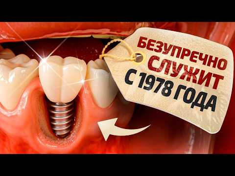 Видео: ЗУБНОЙ ИМПЛАНТ – Дешевый / Средний / Дорогой. Лучшие варианты в 2025 году