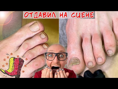 Видео: Педикюр звезде / Онихолизис - отдавил палец на сцене