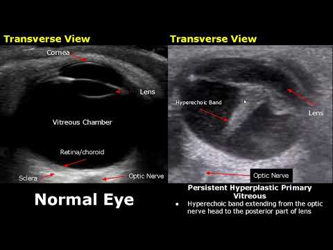 Видео: УЗИ глаза: нормальные и патологические изображения | Катаракта/отслоение сетчатки/разрыв глазного...