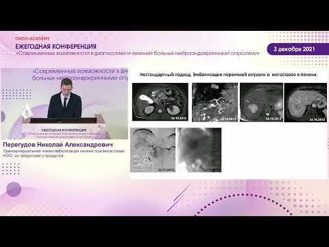 Видео: Трансартериальная химиоэмболизация печени при метастазах НЭО: за пределами стандартов.