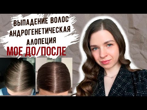 Видео: ВЫПАДЕНИЕ ВОЛОС |  ДО и ПОСЛЕ | Андрогенетическая алопеция #выпадениеволос #алопеция