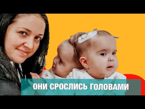 Видео: Сиамские близнецы Бачинские-Мирошник. МЫ С МУЖЕМ СРАЗУ РЕШИЛИ, АБОРТА НЕ БУДЕТ.